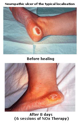 Diabtes foot destr