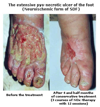 Pyo-necrotic ulcer destr