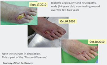 gennyes sebek a lábon kezelés során a diabetes dcont novum tesztcsík